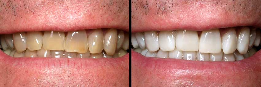 Professional Teeth Whitening Before After