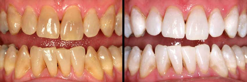 Professional Teeth Whitening Before After