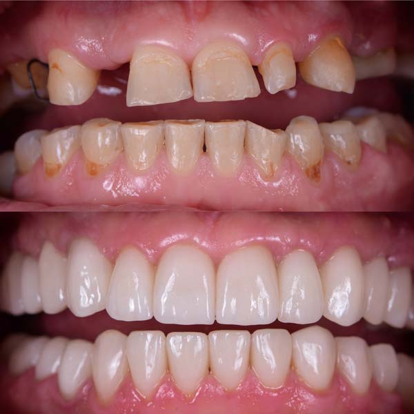 Dental Implants Before & After