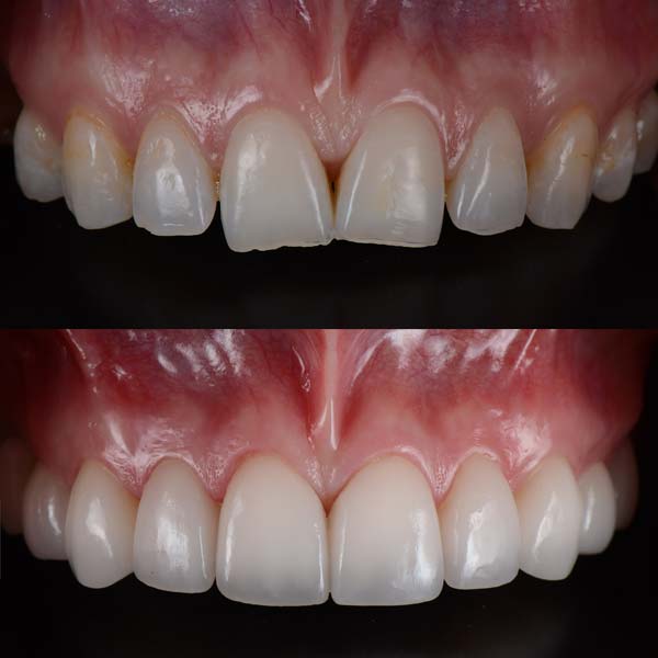 Before & After Porcelain Veneers