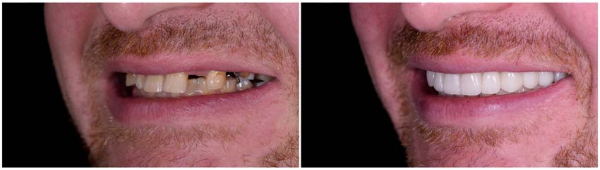 Before & After Patient Secure Denture Implants