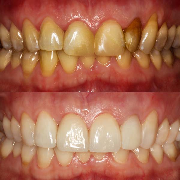 Before & After Teeth Whitening & Cosmetic Bonding