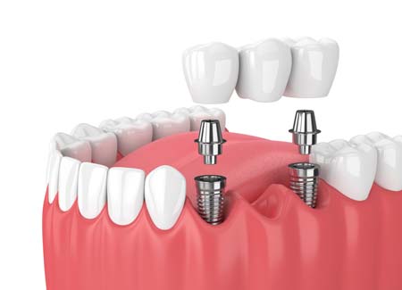 Dental Implant Bridge Illustration