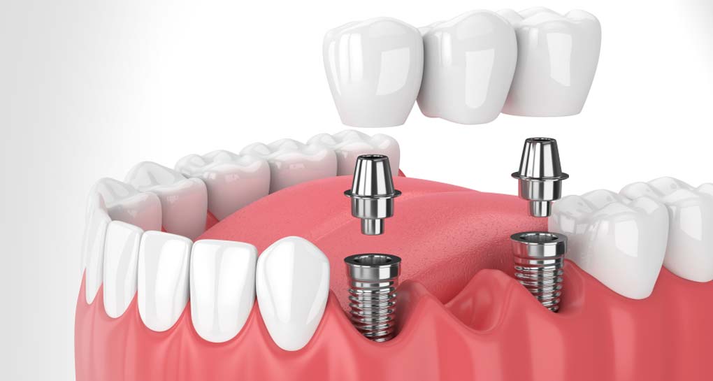 Dental Implant Bridge