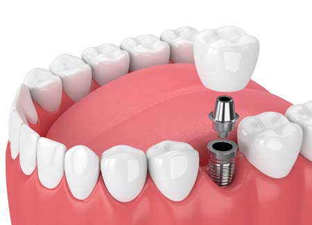 Dental Implant Illustration