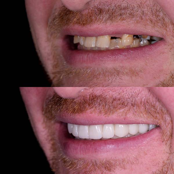 Dental Implants Before & After Smile