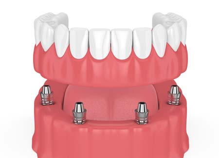 Implant Supported Dentures Illustration