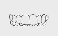 Overbite