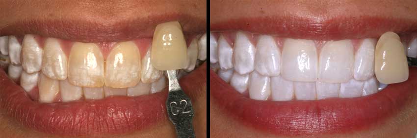 Philadelphia Professional Teeth Whitening Before After