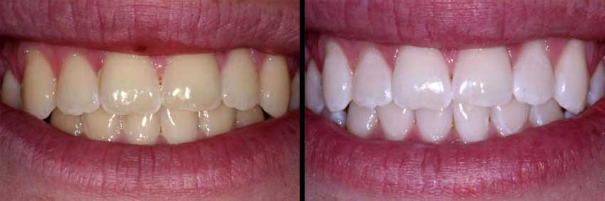 KoR Professional Teeth Whitening Before After