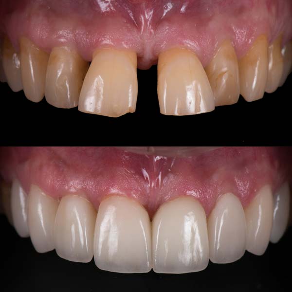 Porcelain Veneers & Teeth Whitening Before & After