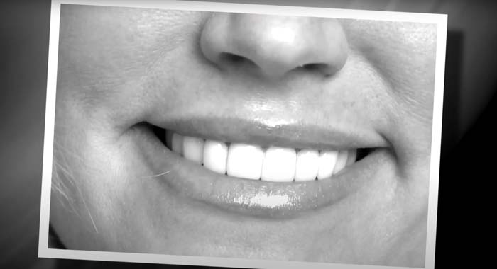 Heather's smile from porcelain veneers