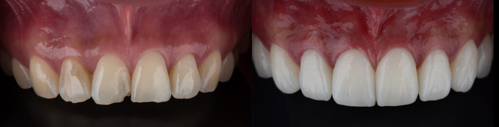 Before And After Lumineers Porcelain Veneers 